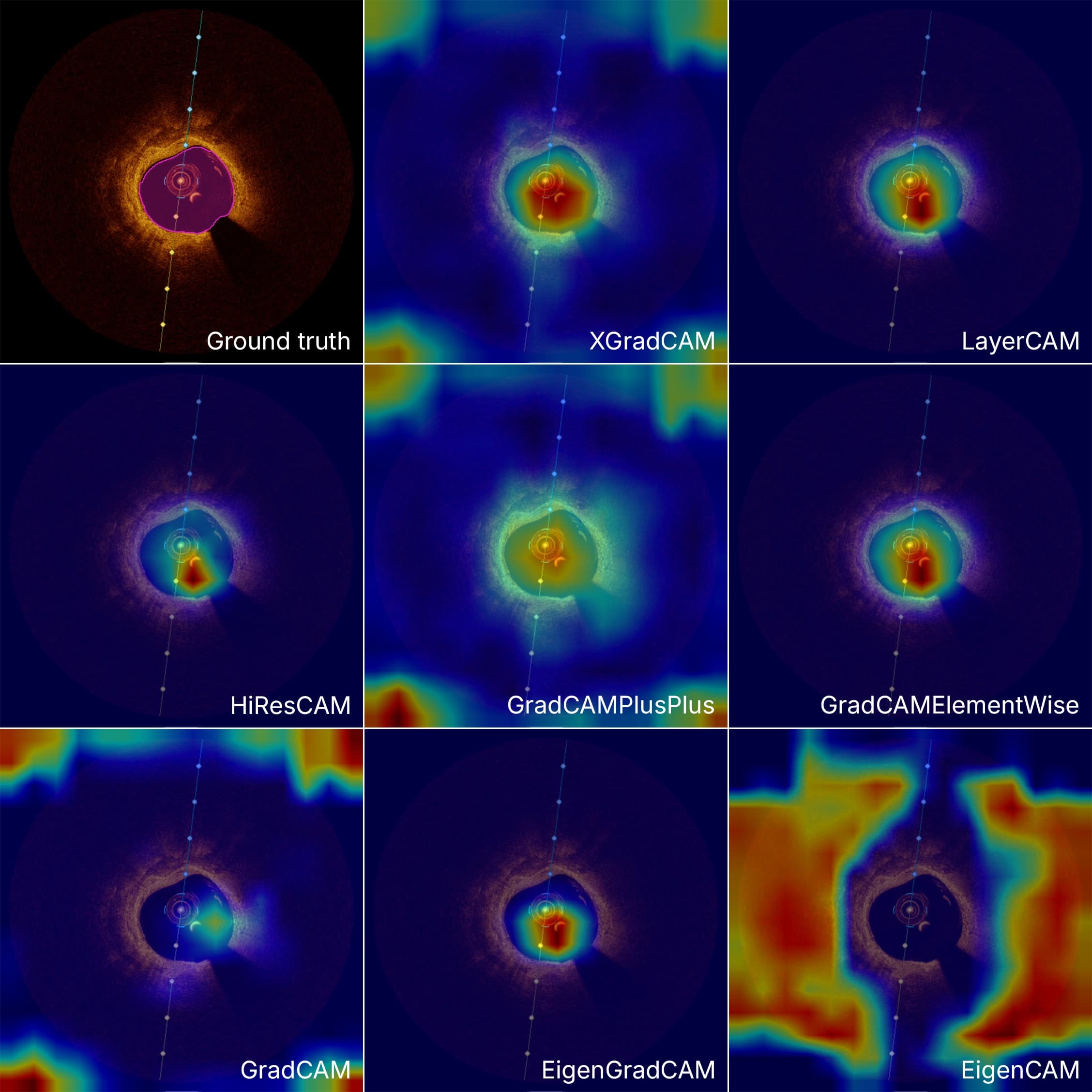 Activation Maps for Lumen Segmentation