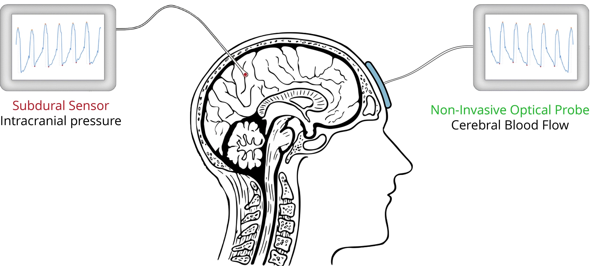 CBF and ICP Acquisition Setup